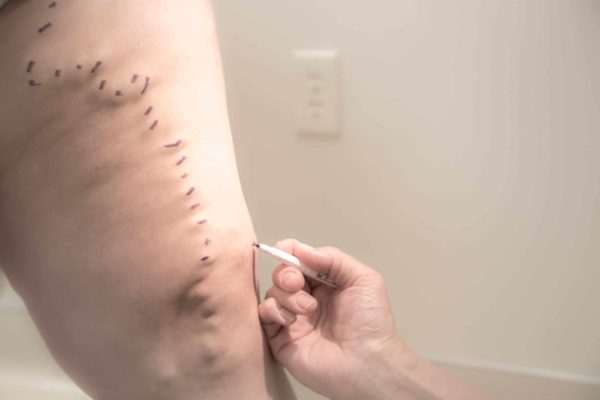 microphlebectomy-vein-treatment