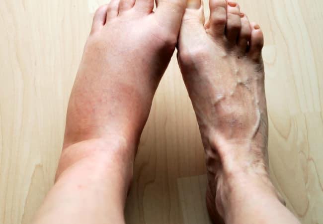 Man receiving ankle edema treatment in salt lake county ut